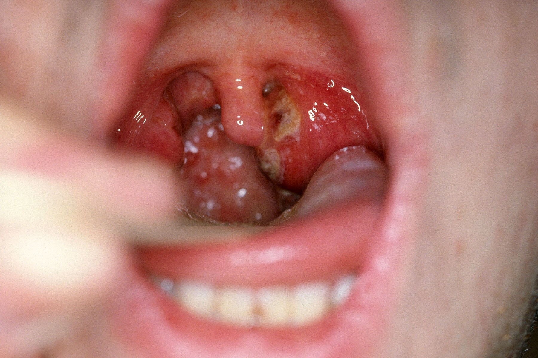 strep throat2